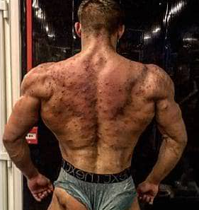 acne bodybuilder