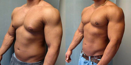 gynecomastia bodybuilding